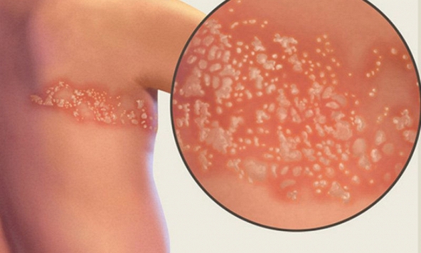 Bệnh giời leo là gì, trị thế nào?