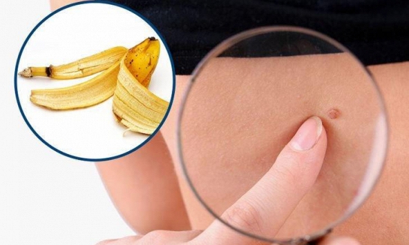 8 cách hiệu quả để loại bỏ các mụn thịt dư