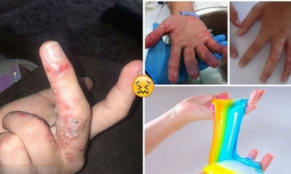 Vì sao 'chất nhờn ma quái' trẻ em khắp thế giới mê mẩn lại khiến nhiều người nhập viện cấp cứu?