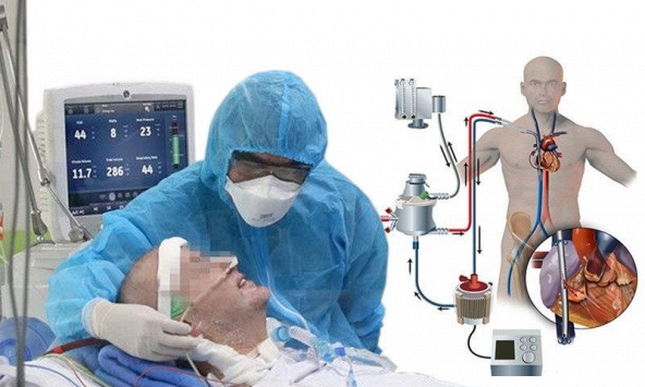ECMO là gì, TP.HCM có thiếu máy ECMO không?
