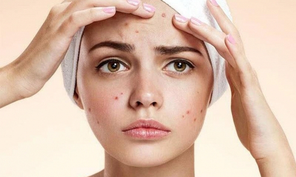 7 lầm tưởng về mụn trứng cá khiến mụn nổi ngày càng nhiều