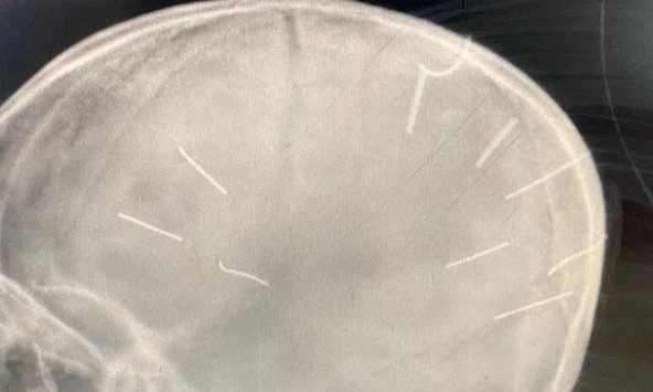 Triệu tập mẹ bé gái có 9 dị vật trong sọ não