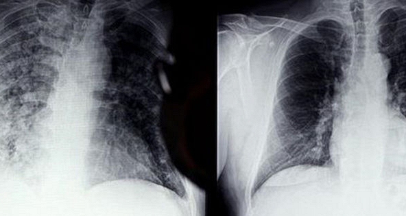 Các triệu chứng thường gặp ở những người từng mắc COVID-19