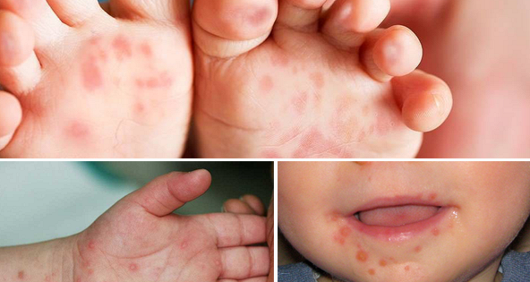 Bệnh tay chân miệng tại TP.HCM tăng gấp 4 lần, cách phòng tránh thế nào?