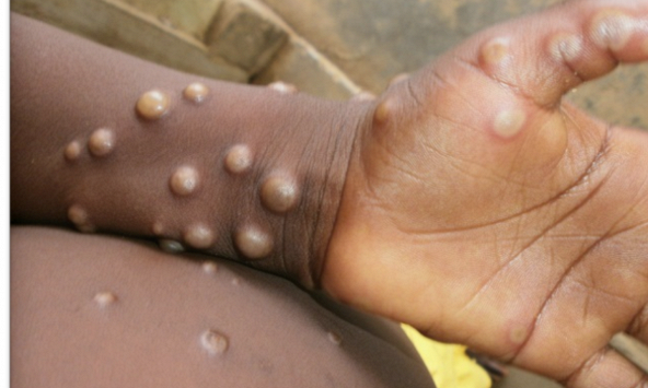 Virus đậu mùa khỉ có tạo nên đại dịch mới?