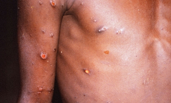 Việt Nam giám sát chặt bệnh đậu mùa khỉ tại các cửa khẩu