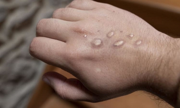 Thế giới có hơn 200 ca bệnh đậu mùa khỉ, tăng gấp 5 lần chỉ sau 1 tuần


