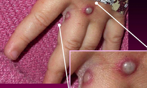 Việt Nam chưa cần tiêm vaccine đậu mùa khỉ