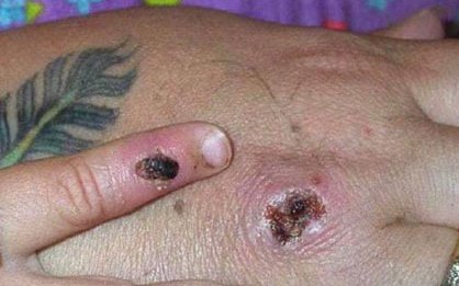 6 ca nghi nhiễm ở Campuchia không mắc đậu mùa khỉ