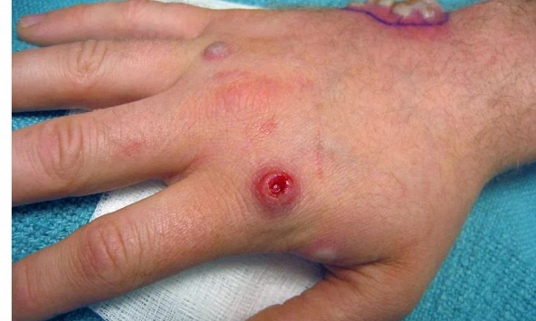 WHO tại Việt Nam: Nguy cơ bùng dịch đậu mùa khỉ tại châu Á là rất thấp