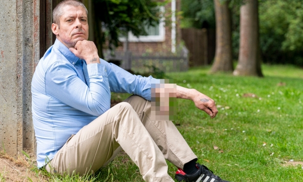 Người đàn ông có dương vật trên cánh tay suốt 6 năm