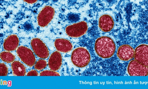 Số ca nhiễm bệnh đậu mùa khỉ tăng, WHO xem xét tuyên bố tình trạng khẩn cấp toàn cầu