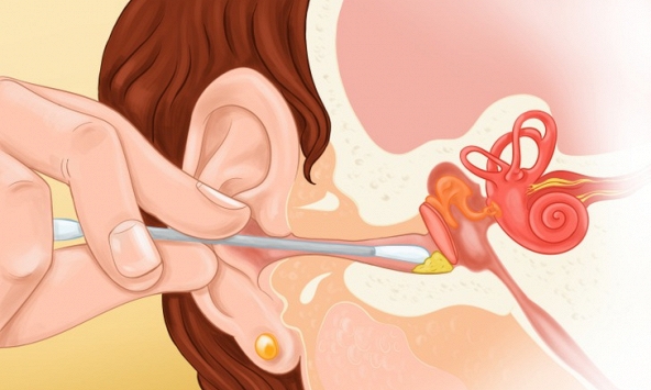 Tại sao bạn nên ngừng vệ sinh tai bằng tăm bông và cách để thay thế