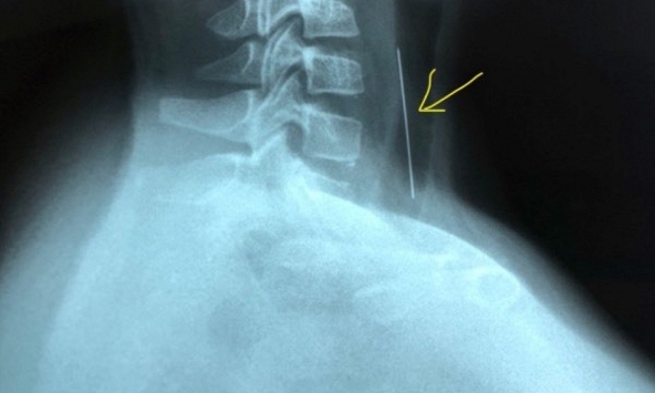 Bé trai 10 tuổi ở Bạc Liêu nuốt phải kim khâu