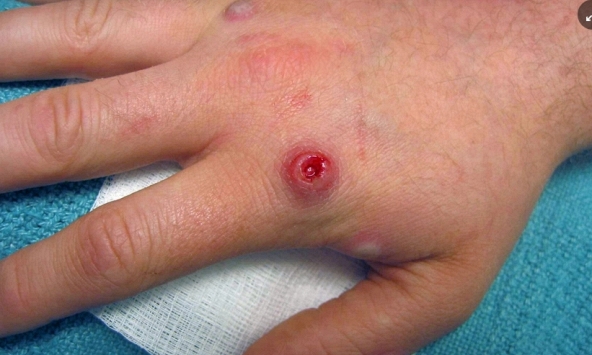 Thế giới ghi nhận 2.103 ca đậu mùa khỉ, thời gian ủ bệnh thay đổi