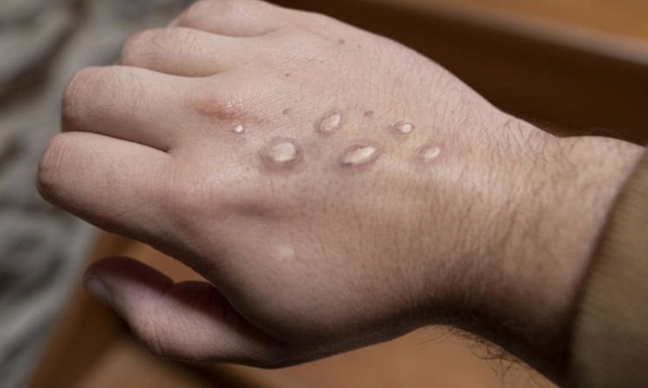 Hàn Quốc, Singapore phát hiện ca nghi mắc đậu mùa khỉ đầu tiên