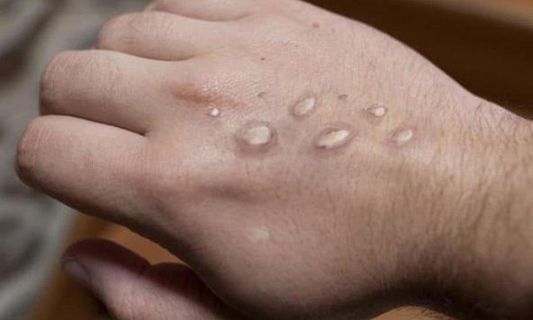 WHO cân nhắc tuyên bố bệnh đậu mùa khỉ là tình trạng khẩn cấp toàn cầu