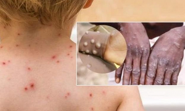 WHO cảnh báo lây nhiễm đậu mùa khỉ ở phụ nữ mang thai và trẻ em