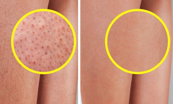 7 mẹo đơn giản hỗ trợ làn da bị viêm nang lông 