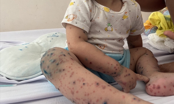 Dịch tay chân miệng và sốt xuất huyết gia tăng tại Hà Nội  