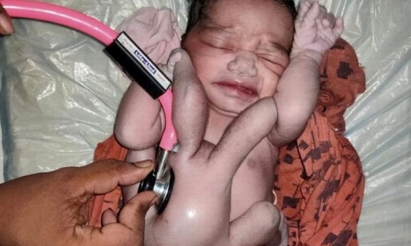 Kỳ lạ em bé sinh ra với 4 tay và 4 chân, được người dân ca tụng là 'phép màu của tự nhiên'