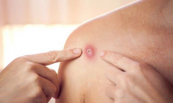 Malaysia ghi nhận ca bệnh đậu mùa khỉ đầu tiên