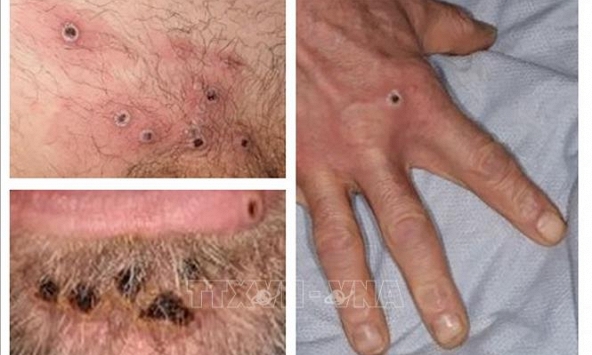 Thế giới ghi nhận 14.000 ca mắc bệnh đậu mùa khỉ 