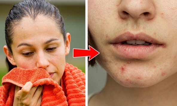 Vị trí của mụn trứng cá trên cơ thể nói lên điều gì?