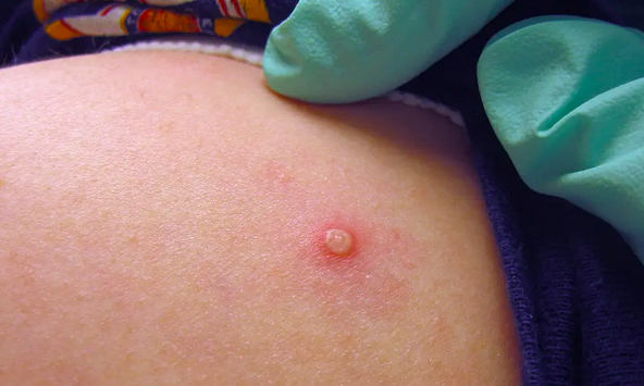 Phòng ngừa sự lây lan của bệnh 'đậu mùa khỉ' bằng cách nào?