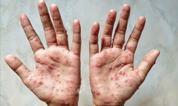 TP.HCM lên phương án ứng phó bệnh 'đậu mùa khỉ'
