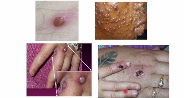 Người dân nên xét nghiệm đậu mùa khỉ nếu có triệu chứng nghi ngờ