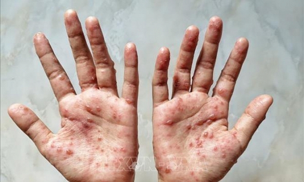 Brazil sử dụng thuốc kháng virus Tecovirimat điều trị bệnh nhân mắc đậu mùa khỉ nặng