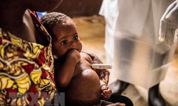 Cảnh báo nguy cơ lây lan virus đậu mùa khỉ ở trẻ em