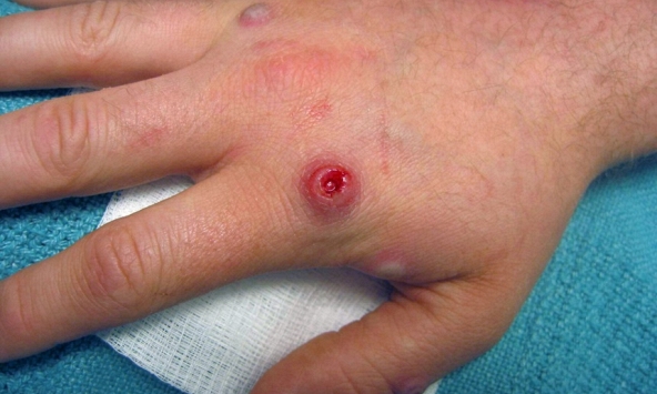 Mỹ tuyên bố đậu mùa khỉ là tình trạng khẩn cấp về sức khỏe cộng đồng