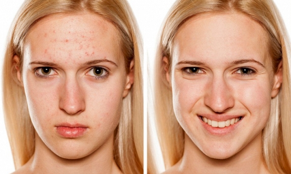 8 mẹo chăm sóc da phổ biến nhưng thực chất rất gây hại