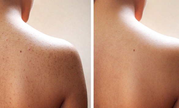 10 mẹo giúp loại bỏ mụn cơ thể mang lại cho bạn sự tự tin