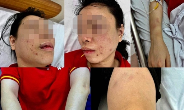 Giám định thương tật người phụ nữ bị chồng cũ 'bắt cóc', đánh đập dã man