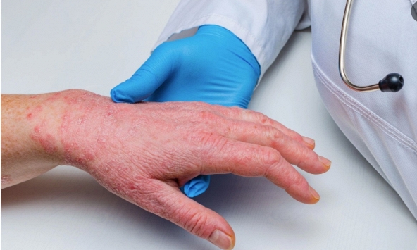 TP.HCM xuất hiện ca bệnh đậu mùa khỉ đầu tiên