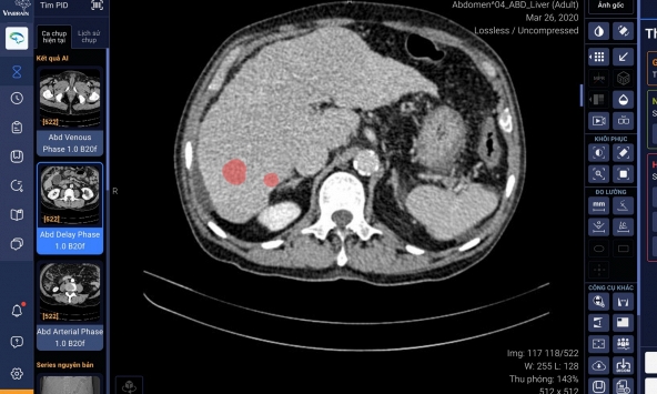 Vinbrain bắt tay Bệnh viện Đại học Y dược TP.HCM phát triển ứng dụng AI, chẩn đoán ung thư gan