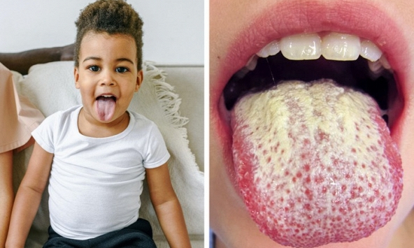 Lưỡi trắng là bệnh gì và phải làm gì khi mắc phải?