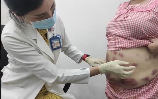 Một phụ nữ bị biến chứng sau khi tiêm thuốc tan mỡ bụng