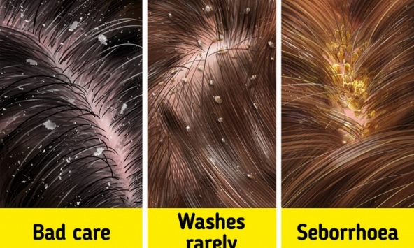 Lý do gàu xuất hiện và cách điều trị hiệu quả