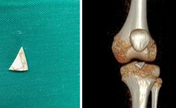 Phẫu thuật lấy mảnh sành sắc nhọn 'nằm yên' 2 năm trong khớp gối bé gái 9 tuổi
