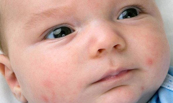 5 Bệnh ngoài da hay gặp ở trẻ mùa nắng nóng