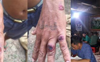 Bộ Y tế cảnh báo nóng về 3 ổ dịch bệnh than tại Điện Biên