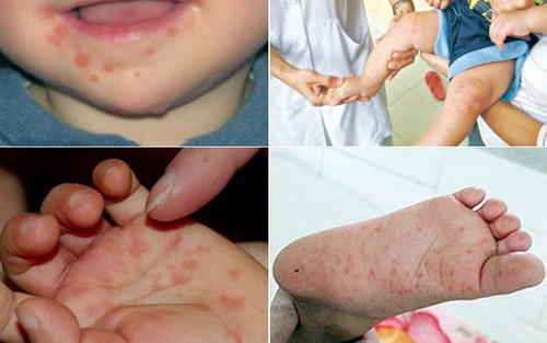 1 trường hợp tử vong nghi do bệnh tay chân miệng, Bộ Y tế khuyến cáo phòng chống bệnh
