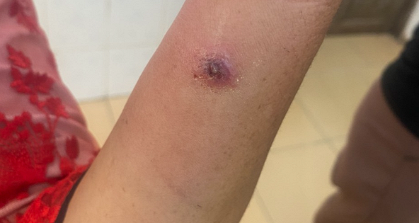 Điện Biên ghi nhận trường hợp trẻ nhỏ mắc bệnh than