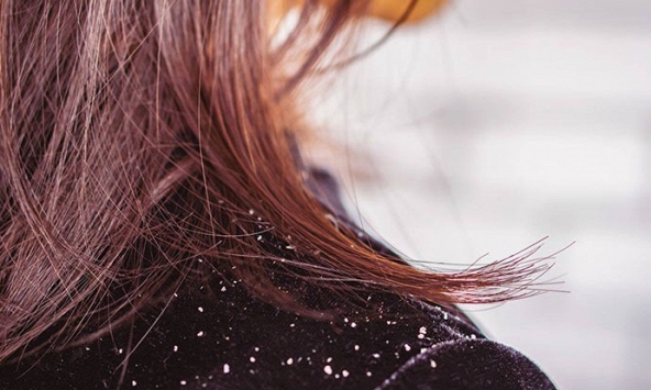 Cách phân biệt gàu và nấm da đầu để tránh nhầm lẫn