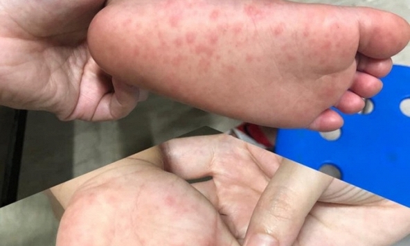 TP.HCM lo thiếu thuốc điều trị tay chân miệng nặng, Bộ Y tế nói gì?