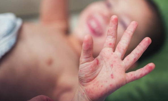 Bác sĩ chỉ ra 3 dấu hiệu 'kinh điển' trước khi bệnh nhân tay chân miệng chuyển nặng